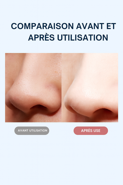 Appareil Skin Scrubber Ultrason – Nettoyeur de Pores, Éliminateur de Points Noirs et Soin Liftant Visage Professionnel